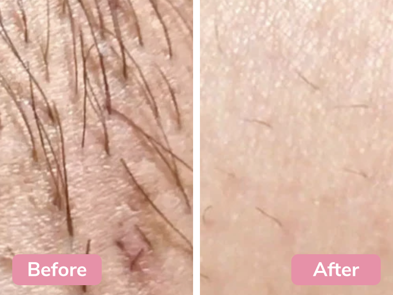 Nulux™ - Permanent hair removal solution